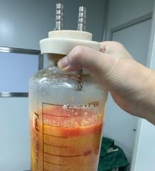 雄安水动力吸脂手术要做多久？